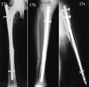Hospital Ney Arias Lora elimina ventas irregulares de materiales de osteosíntesis a pacientes