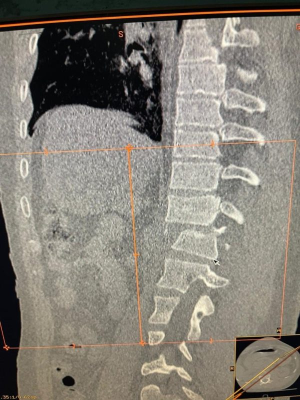 Cirujanos del Gautier esperanzados tras cirugía a mujer sufrió fractura columna